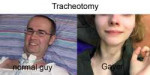 Tracheotomy.jpg