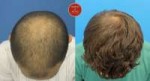 dr-hasson-8364-2-sessions-fut-8-months-post-op-crown-compare.jpg