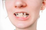 braces-ceramic.jpg