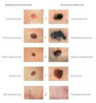 nevus-i-melanoma.jpg