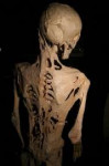 Fibrodysplasiaossificansprogressiva.jpg