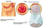 colostomy11.jpg